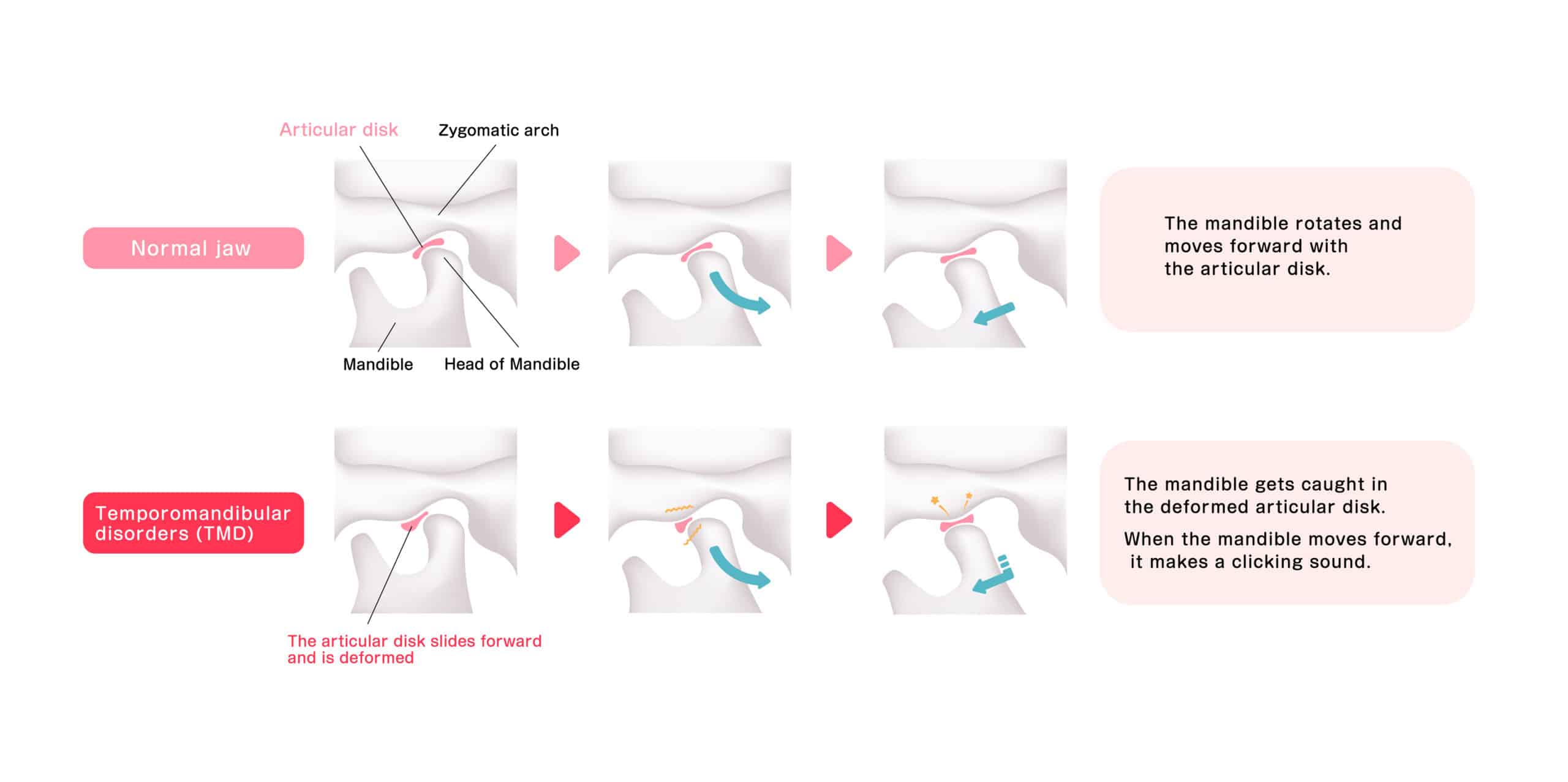 Comparison illustration of normal jaw and Temporomandibular disorders (TMD)