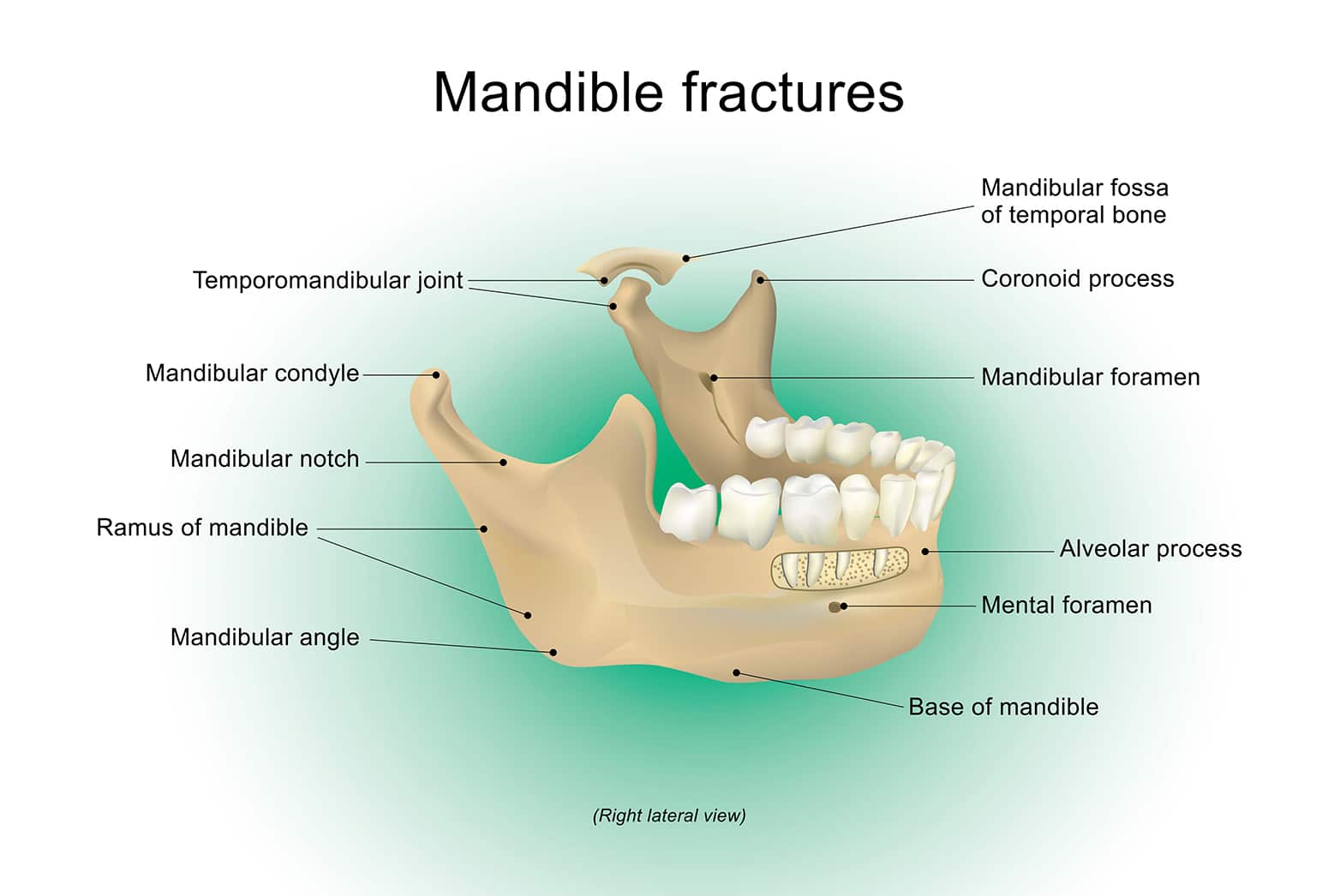 Mandible fractures