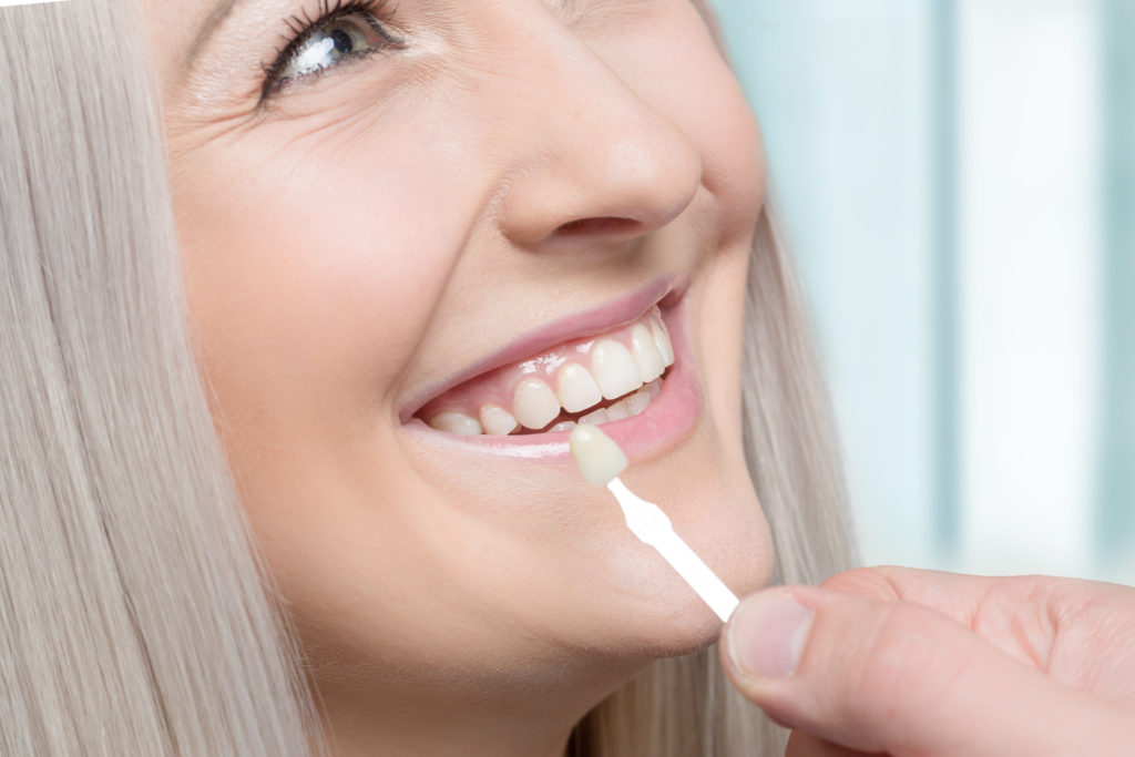 How often do veneers need to be replaced?